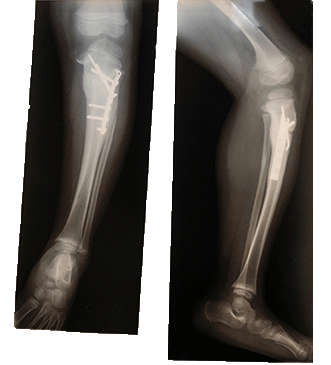 Two x-rays of child's lower eg